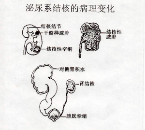 泌尿系结核病理过程