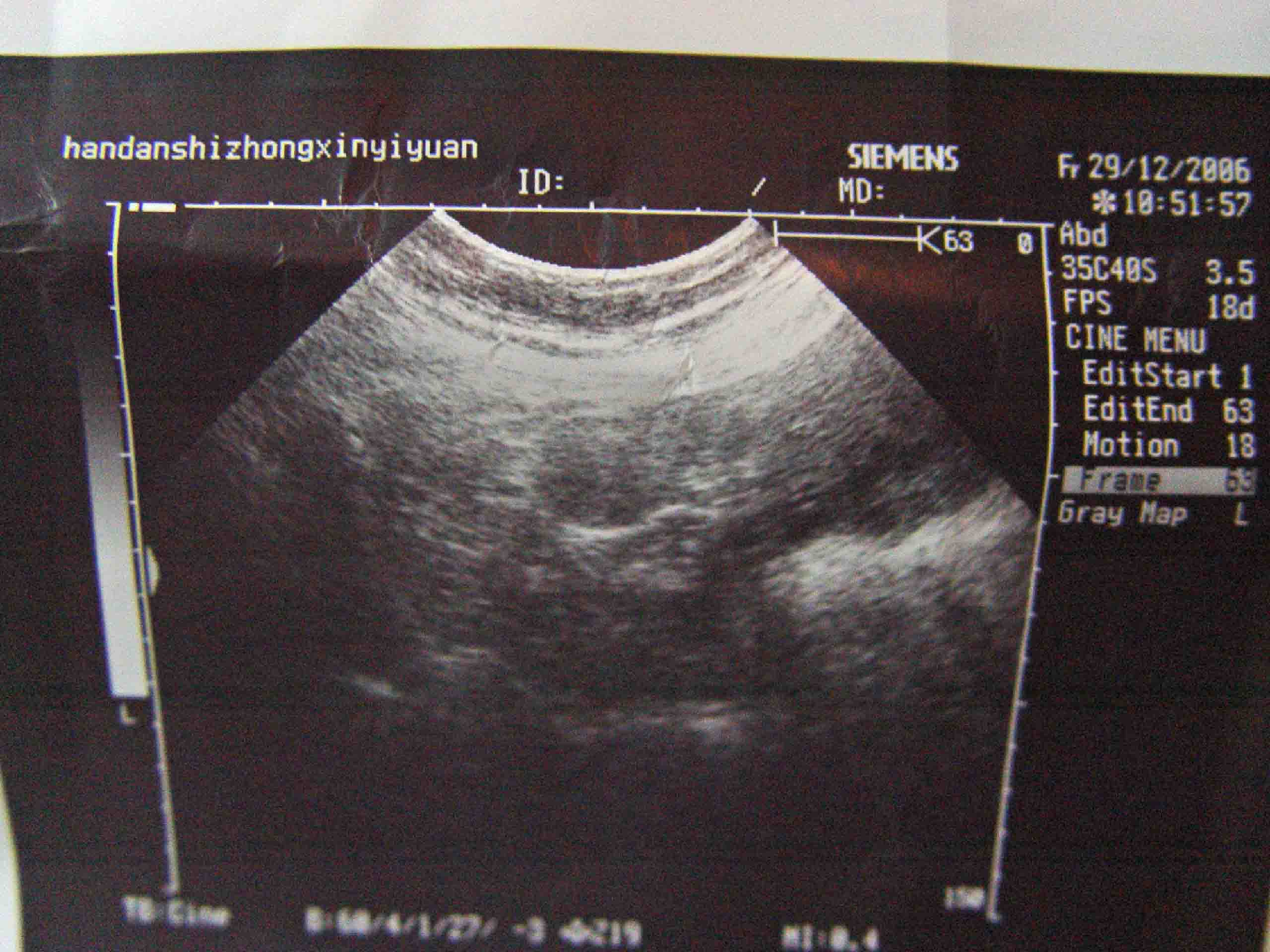 妊娠图:将孕妇体重,血压,腹围,宫底高度,胎位,胎心,水肿,蛋白尿,超声