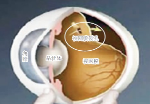 视网膜锯齿缘离断图片图片