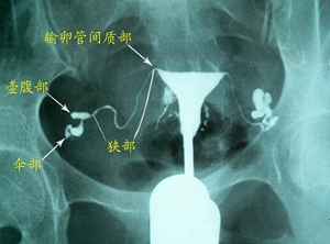 输卵管堵塞性不孕