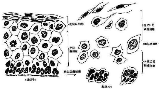 畸形癌細胞