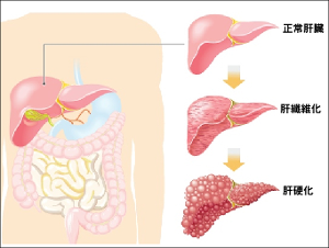肝炎肝硬化