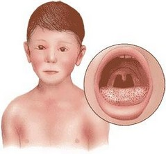 2病因有关烂喉痧[1]的系统论述主要见于清代医学文献