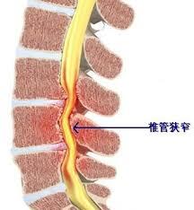 腰椎管狭窄症