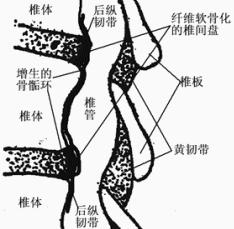 腰椎管狭窄症