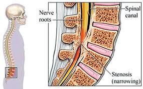 腰椎管狭窄症
