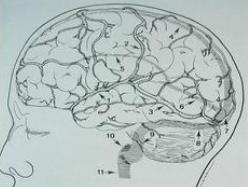 上矢状窦血栓形成