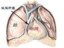 縱隔間葉源性腫瘤及其他腫瘤