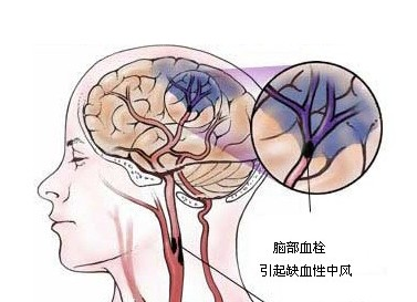 缺血性脑中风