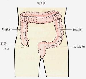 肠扭结
