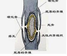 眶骨髓炎