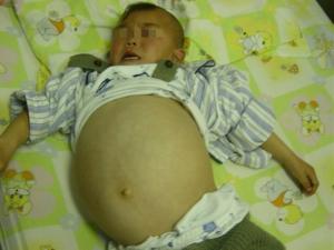 小儿肝母细胞瘤