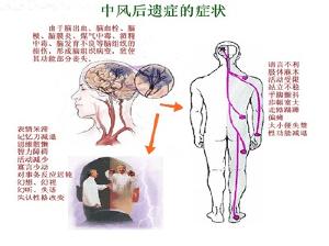 脑血栓后遗症