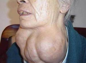 毒性弥漫性甲状腺肿