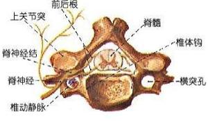 极外侧型腰椎间盘突出症