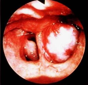 鼻前庭血管瘤图片