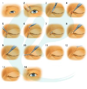 开外眼角手术过程图图片
