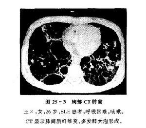 特发性间质性肺炎