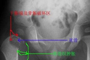 骨骺点状发育不良