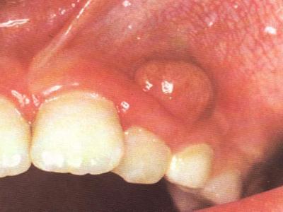 急性根尖周炎是从根尖部牙周膜出现浆液性炎症到根尖周组织形成化脓