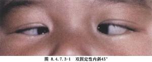 固定性斜视