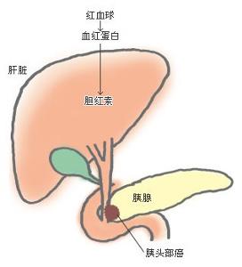 实验室检查7检查胰腺假性囊肿须与胰腺脓肿和急性胰腺蜂窝织炎鉴别.