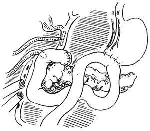 (2)十二指肠破裂时,气体常进入横结肠系膜内,为了避免与横结肠内气体