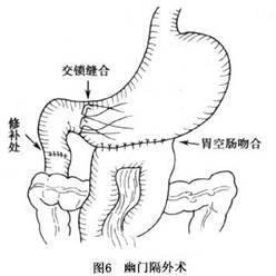 十二指肠损伤