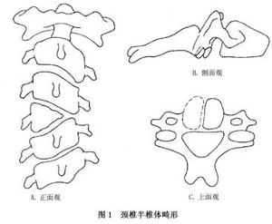 颈椎半椎体畸形