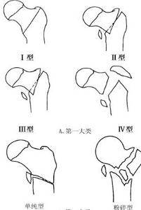 股骨转子下骨折