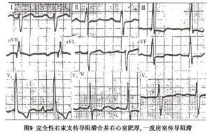 右束支传导阻滞 搜狗百科