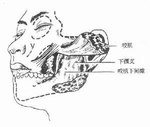 颌面部炎症