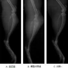 恶性骨肿瘤