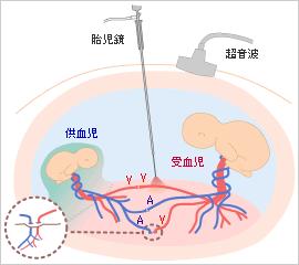 胎儿镜及激光阻断血管连接