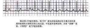 自律性房性心动过速的“温醒”现象.jpg