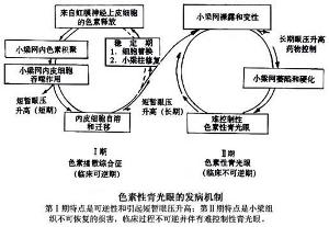 色素性青光眼发病机制