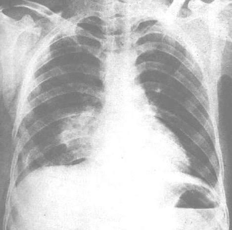 肺挫伤 搜狗百科