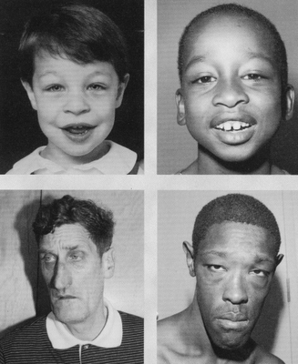 脆性x染色体综合征 - 搜狗百科