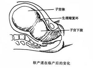 软产道损伤图片