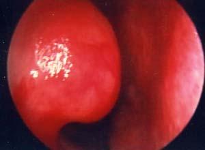 鼻粘膜充血肿胀图片图片