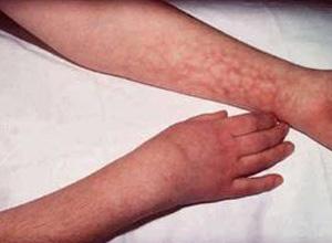 上肢及面部血管曲张水肿及青紫