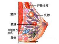 乳腺导管乳头状肿瘤图片