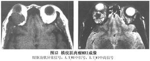 眼眶横纹肌肉瘤MRI成像
