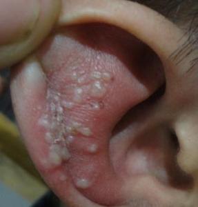 儿童耳朵带状疱疹图片图片