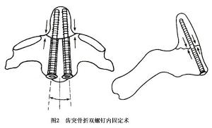 枢椎齿突骨折