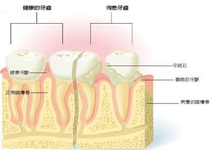 牙石,食物嵌塞,不良修复体等,可促使菌斑和服聚,引发或加重牙龈的炎症