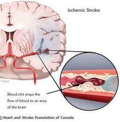 的患者,伴有束臂加压征(trousseau征)及面神经叩击征(chvostek征)阳性