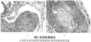 急性海绵窦栓塞性静脉炎