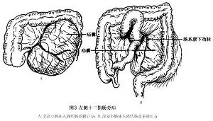 十二指肠旁疝