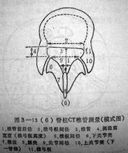 椎管测量示意图图片